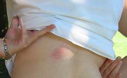 Bee Sting by SpaceNinja Bee Sting by SpaceNinja