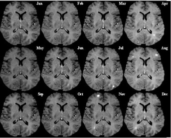 Monthly Multiple Sclerosis MRI