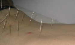 Acupuncture by Kafka for Prez