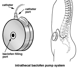 intrathecal baclofen pump system