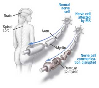 demyelination in MS