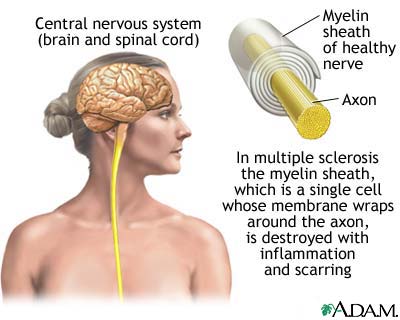 Multiple Sclerosis brain diagram w nerves