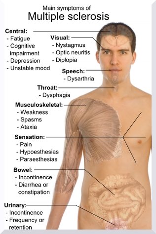 signs of multiple sclerosis