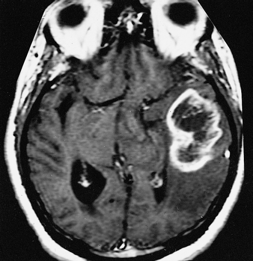 Tumefactive MS with Open Ring Enhancement