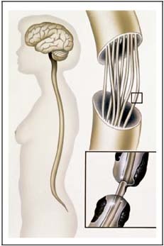 CNS Diagram w Spinal Cord Damage