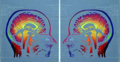 Face Off IV, solarplate etching based on the artist's MRI